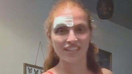 Love Island star left with horrific injury as skin is ripped off after motorbike crash