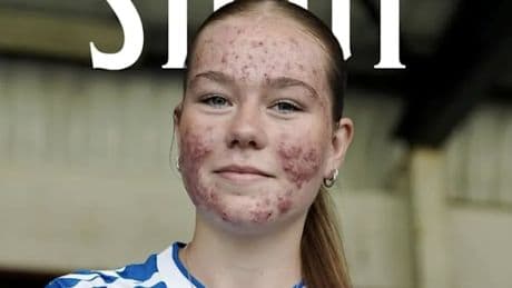 Wegen ihrer Akne wird diese 16-Jährige massiv angefeindet