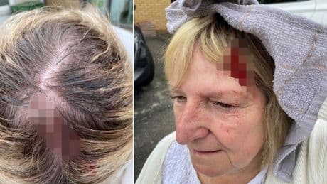 Seagull ‘whacks’ into woman leaving her with bloody head wound