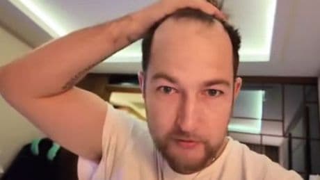 Man, 35, gets £3,220 hair transplant to avoid looking like one family member