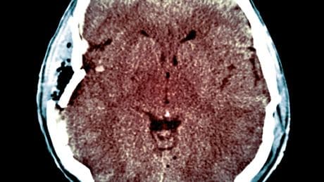 A New System Aims to Save Injured Brains and Lives