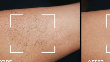 'Painless' hair removal device that works in 'weeks' and saves on waxing is £140 off