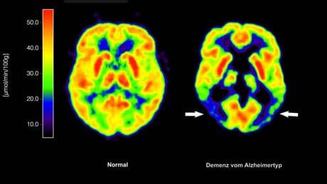 EU-Kommission lässt Wirkstoff Lecanemab gegen Alzheimer zu