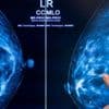 Programm zur Früherkennung: Mammografie-Screening senkt Brustkrebs-Sterblichkeit
