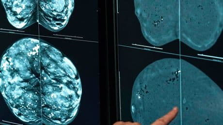 One Type of Mammogram Proves Better for Women With Dense Breasts