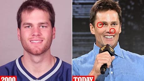 Plastic surgeons reveal what could be behind Tom Brady's changing appearance