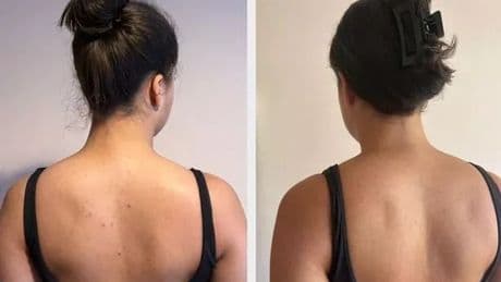 'These skin smoothing pads dramatically reduced my keratosis pilaris in one month'