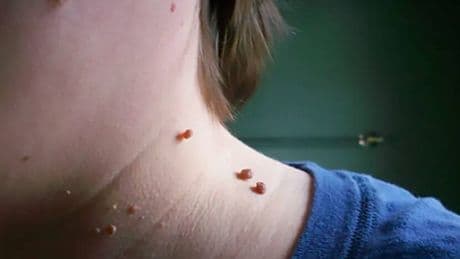 Cómo eliminar las verrugas del cuello: esto debes saber sobre ellas