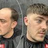 When I started balding in my teens I was so insecure. Then I discovered the hair-loss miracle men whisper about and it changed my life. No, it's NOT a transplant - you'll never guess my secret