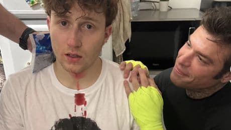 Fedez rompe il naso al Rosso in diretta, la corsa in ospedale: cosa è successo