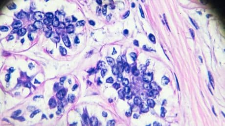 ‘Transformational’ new breast cancer drug could halt the growth of tumours