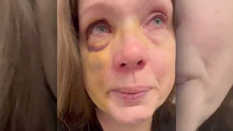 Mom knocked out in Cincinnati mob attack breaks silence after suffering ‘brain trauma’