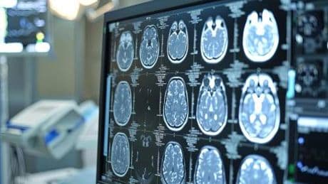 Telemedicina, progetto telestroke permette di trattare ictus a distanza