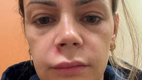 Mum rushed to hospital and unable to smile after popping pimple on face