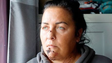 Mum and daughter scarred for after bully dog rips into faces in horror attack