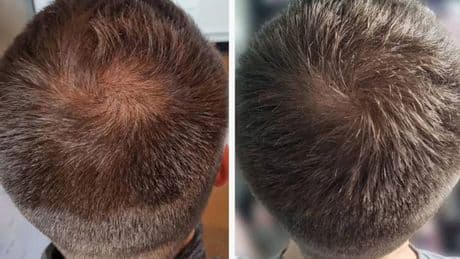 Hair loss sufferer says hairdresser 'couldn't believe' growth with 55p-per-day supplement