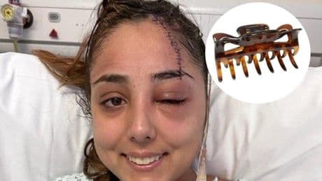 Pinzas para el pelo incrustadas en el cráneo tras un accidente de tráfico: el nuevo peligro que se extiende por TikTok