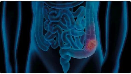Tumori, le donne si ammalano più degli uomini: colpa di alcol e fumo. Il secondo bicchiere aumenta del 27% il rischio di cancro al seno