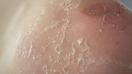 Trügerisches Wetter: Diese App weiß, wann Sonnencreme Pflicht ist