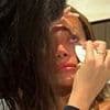 Woman uses slices of HUMAN PLACENTA to cure common, painful eye condition - would you try it?