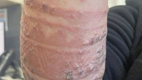 Mum shares horror pictures after son gets henna tattoo on Bali holiday
