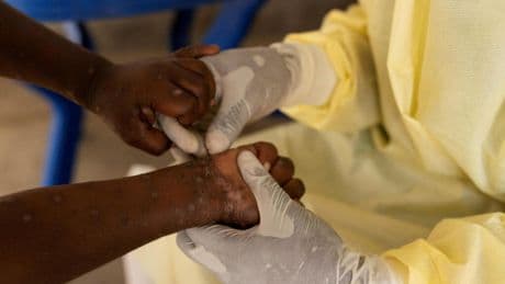 Togo: premiers cas de Mpox détectés à Lomé, les autorités sanitaires en alerte