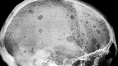 From No Hope to a Potential Cure for a Deadly Blood Cancer