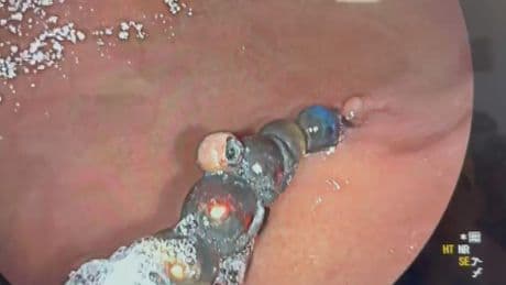 Doktorları bile şoke eden vaka: Karnında 66 adet mıknatısla aylarca hayatta kaldı