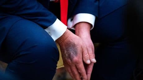 Vascular surgeon explains warning signs a 'Trump bruise' is serious
