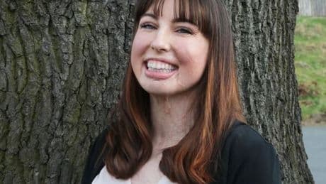 Britain's most badly burned woman feels lucky to be alive and helping patients like her