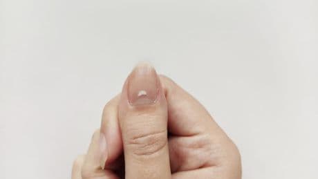 Zinkmangel: Ursachen und Symptome