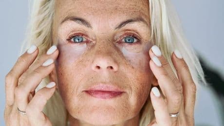 Doctor shares six ways to tackle condition seen in lower eyelid