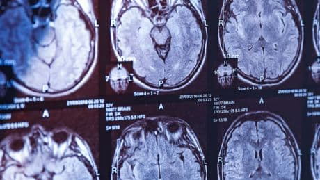 Alzheimer araştırmalarında riski artıran genetik varyant bulundu