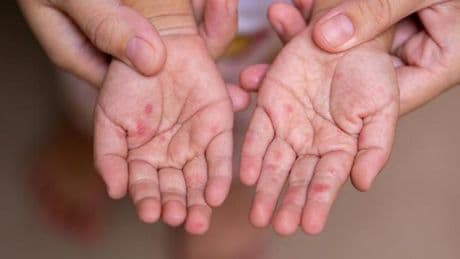 El Ayak Hastalığı Belirtileri Nelerdir? El Ayak Hastalığı Nasıl Anlaşılır? Tedavi Yöntemleri Nelerdir?