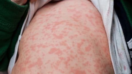 Measles has exploded in Texas, but state could let more kids skip vaccines