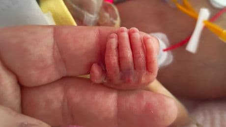 Kleine Chloe kam 15 Wochen zu früh  - Eine ganze Hand so groß wie Papas Fingerspitze