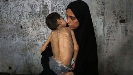 +++ Nahost +++: WHO meldet 12.000 akut unterernährte Kinder in Gaza