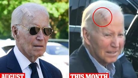 What is Mohs surgery? The precise technique used to remove skin cancer from Joe Biden