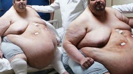 310 kiloya ulaştı! “Ölmek için dua ettim” dedi, yıllar sonra ilk adım