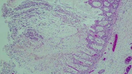 UK health warning after cases of deadly bacteria C. diff soar to 12 year high