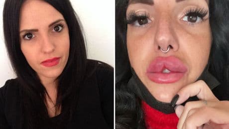 «Sfigurata da un filler low cost. Volevo le 'labbra alla russa'»: la denuncia di Federica, sfigurata dall'iniezione di una dottoressa bulgara