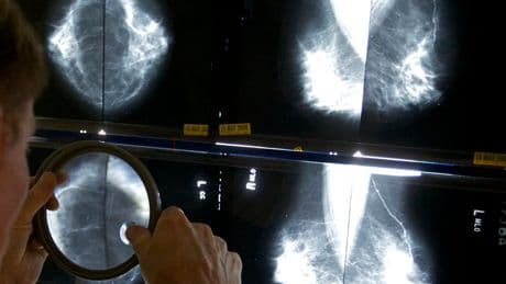 ‘Pivotal’ new breast cancer drug can help stop tumours early
