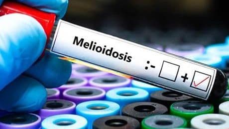 Avustralya'da melioidoz salgını! Can kaybı 31'e çıktı