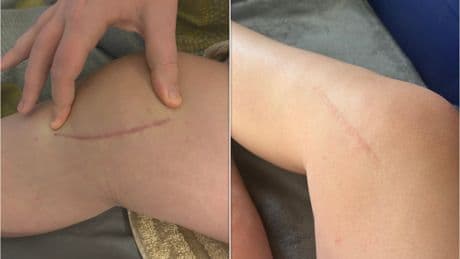 I Tried TikTok's Viral Method For Fading Scars. The Difference Is Staggering