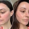 I'm a beauty editor, and this skincare routine ruined my face and gave me an itchy mouth rash. Here's how I cured the problem... and it'll work for you too