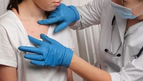 Child with measles dies in hospital as experts fear virus 'could spread like wildfire'
