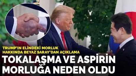 Trump'ın elindeki morluk hakkında Beyaz Saray'dan açıklama: Sık tokalaşma ve aspirin morluğa neden oldu