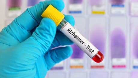 Why Blood Test For Early Detection Of Alzheimer’s Disease Matters