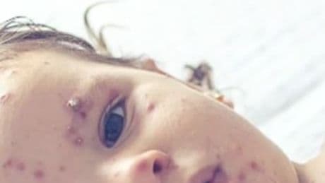 Confirmed cases of measles in Alberta now at 326, continue to rise