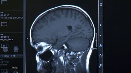 Prognose bis 2050: Zahl der Parkinson-Erkrankungen könnte drastisch steigen